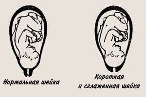 Длина шейки матки