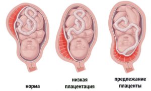 Низкая плацентация