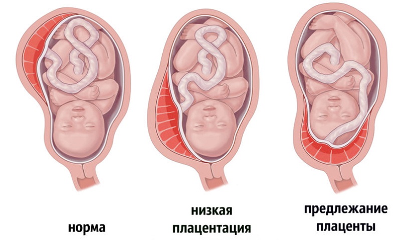 Низкая плацентация