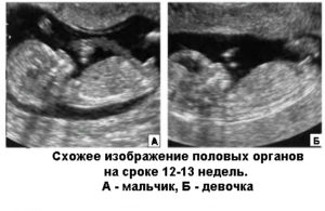 Определение пола плода по узи