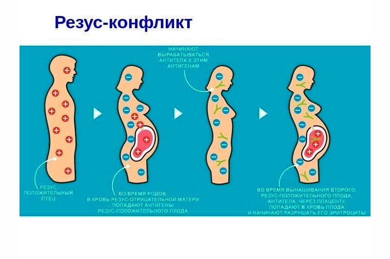 Резус-конфликтная беременность